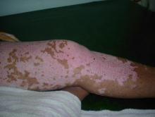 Trusted results in Vitiligo (leucoderma)